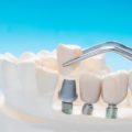 close-up-implan-tooth-support-fix-bridge-implan-crown