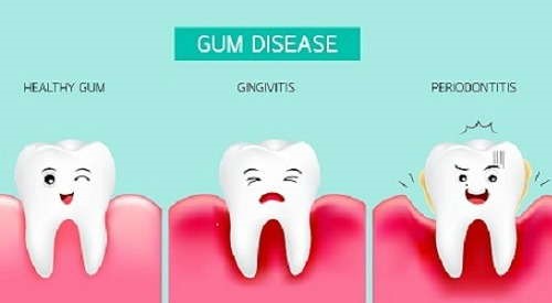 Different stages of gum diseases